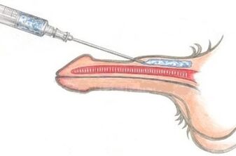 A dangerous method to enlarge the penis using Vaseline injections. 